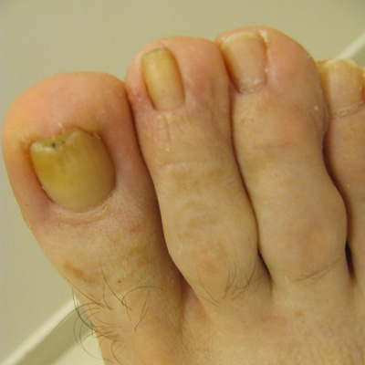 ICD-10 Code for Toenail Fungus: Quick Guide & Tips ICD-10 Code for Toenail Fungus: Quick Guide & Tips
